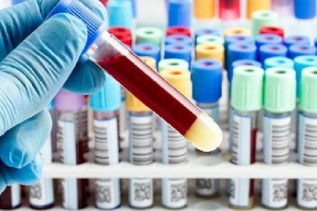 அரியாலை ஆராதனையில் கலந்துகொண்ட 64 பேரின் பரிசோதனை முடிவுகள் வெளியானது!