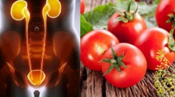 தக்காளி நிறைய சாப்பிட்டா கிட்னில ஸ்டோன் வருமா?