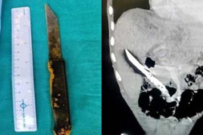 வயிறு வலியால் துடித்த நபர்… கல்லீரலில் சொருகி இருந்த கத்தி!