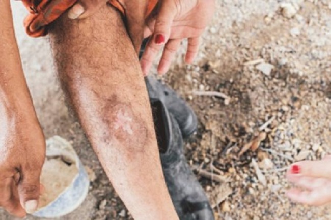 இலங்கையில் பரவும் மற்றொரு ஆபத்தான நோய்: அநுராதபுரத்தில் அடையாளம்!