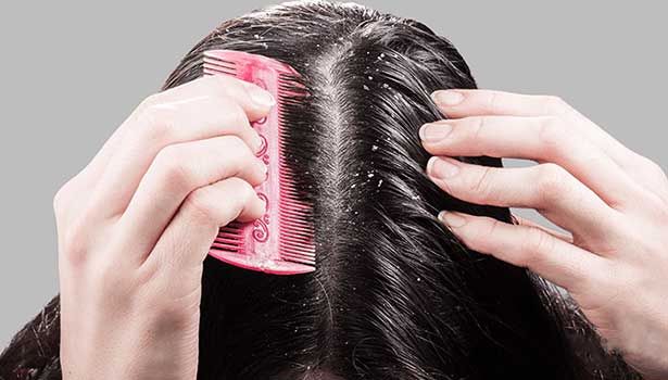 பொடுகு பிரச்சனையில் இருந்து தலைமுடியை பாதுகாப்பது எப்படி