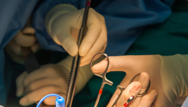 அமெரிக்காவில் மூளைச்சாவு அடைந்தவருக்கு பன்றியின் சிறுநீரகம்