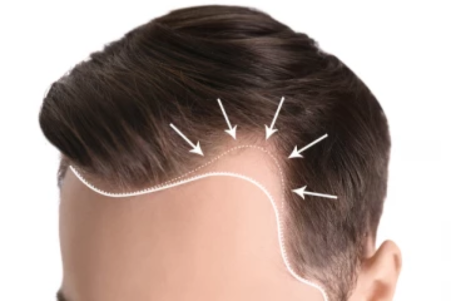 வழுக்கை தலையில் கிடுகிடுவென முடி வளர வேண்டுமா?