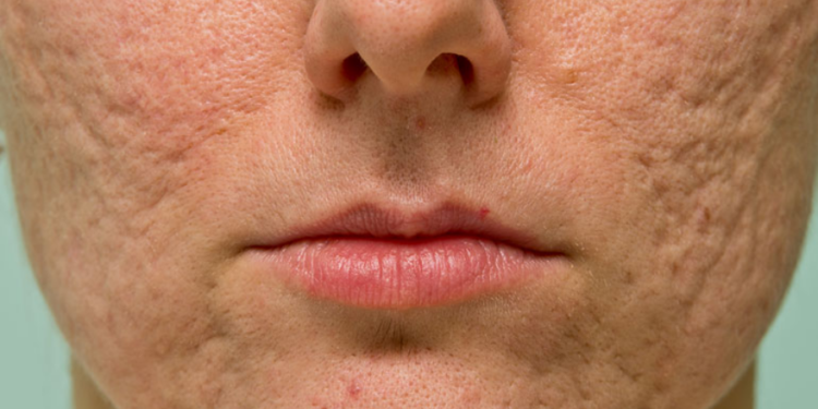 சருமத்தில் ஏற்ப்படும் குழிகளை போக்குவது எப்படி? சிறந்த வழிமுறைகள் இதோ