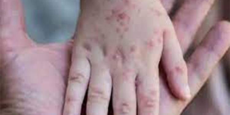 குரங்கம்மை குறித்து குழந்தை நல மருத்துவர் தீபால் பெரேரா கூறியுள்ள விடயம்