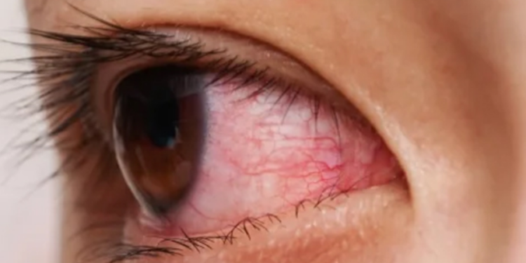 வேகமாக பரவி வரும் கண்நோய்