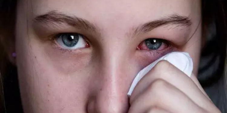 மெட்ராஸ் ஐ: அறிகுறியும்.. தற்காப்பு முறைகளும்..