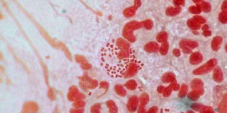 கனடாவில் பாலின நோய் தொடர்பில் எச்சரிக்கை விடுப்பு!