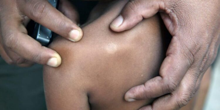 இவ் வருடத்தில் மாத்திரம் 105 சிறுவர்கள் தொழுநோயால் பாதிப்பு!