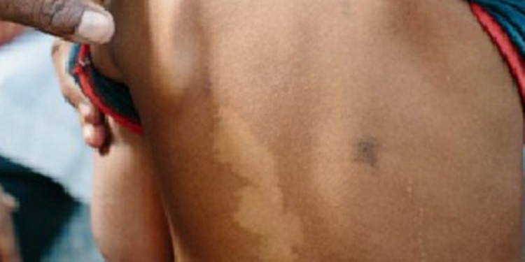 நாட்டில் தொழுநோயால் பாதிக்கும் சிறுவர்கள்