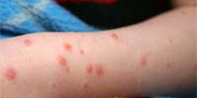 இலங்கையில் மீண்டும் பரவும் சின்னம்மை நோய்!