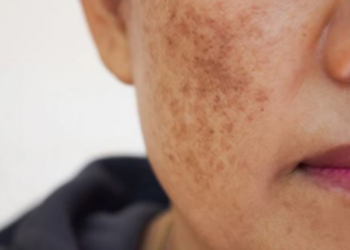 முகத்தில் உள்ள கரும் புள்ளிகளை வீட்டில் உள்ள பொருட்களை வைத்து போக்க இலகு முறை!