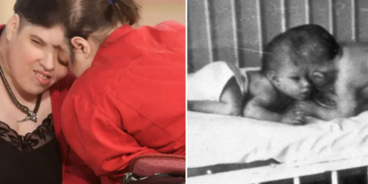 ஒட்டிப் பிறந்த சகோதரிகள் மரணம்!