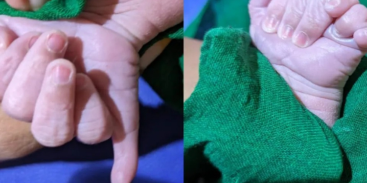 25விரல்களுடன் பிறந்த அதிசய குழந்தை!