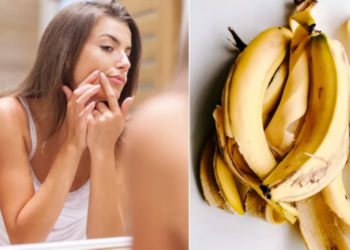 முகப்பருவைத் தடுக்கும் வாழைப்பழ தோல்