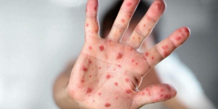 கானடாவில் தட்டம்மை  குறித்து எச்சரிக்கை!