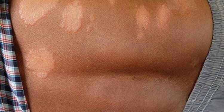 இலங்கையில் தொழு நோயாளர்களின் எண்ணிக்கை அதிகரிப்பு!