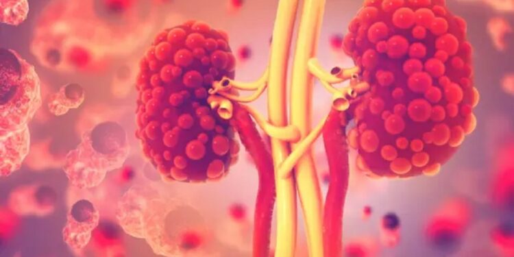 சிறுநீரக நோயால் நாளாந்தம் 5 பேர் பலி!