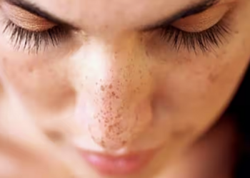 இந்த ஸ்கிரப் போடுங்க கரும்புள்ளி இருந்த இடமே தெரியாது