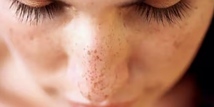 இந்த ஸ்கிரப் போடுங்க கரும்புள்ளி இருந்த இடமே தெரியாது