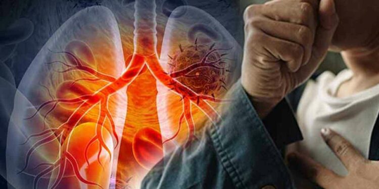 பெண்களை விட ஆண்களுக்கு நுரையீரல் புற்றுநோய் பாதிப்பு அதிகரிப்பு!