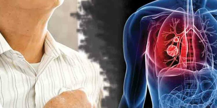 நாட்டில் நுரையீரல் புற்றுநோயாளர்களின் எண்ணிக்கை அதிகரிப்பு!